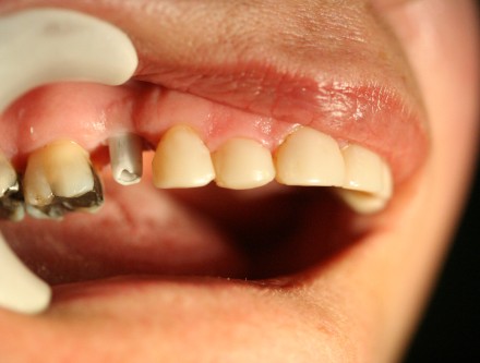 cosmetic dental implant crown by Mark Dennis, DDS