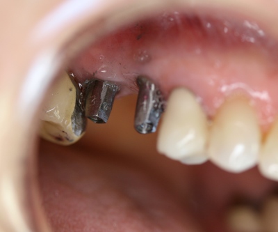 implants and reconstruction by Mark Dennis, DDS