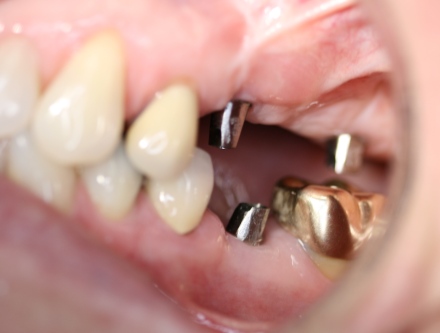Implant reconstruction by by Mark Dennis,DDS