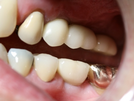 implant reconstruction by Mark Dennis, DDS