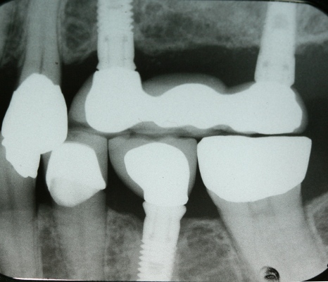Implant reconstruction by Mark Dennis,DDS