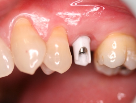 implant dentistry by Mark Dennis, DDS