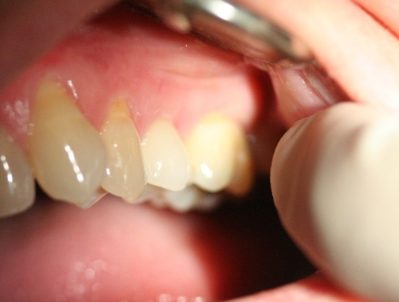 cosmetic dental implant crown by Mark Dennis, DDS