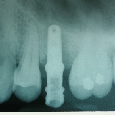 Dental implant by Gregg Bobier, DMD