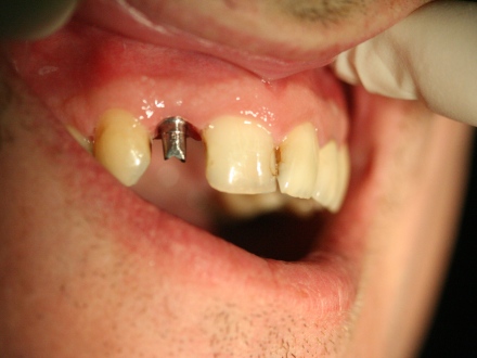 implants and reconstruction by Mark Dennis, DDS