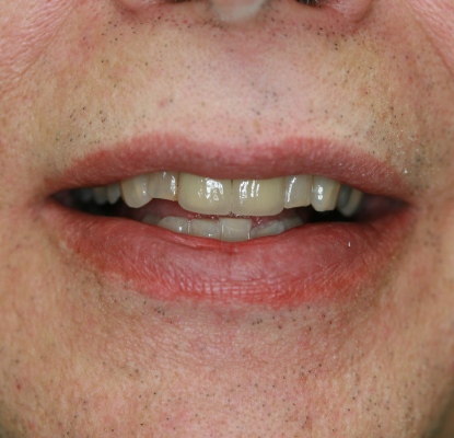 cosmetic crowns by by Mark Dennis,DDS