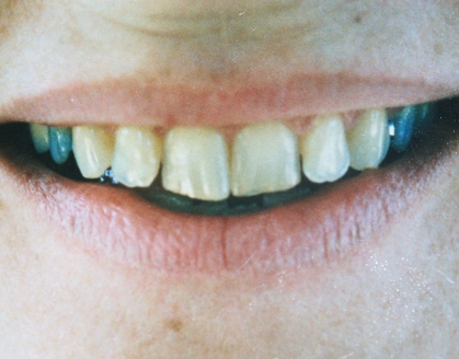 before porcelain laminate veneers by Mark Dennis, DDS