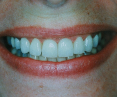 porcelain laminate veneers by Mark Dennis, DDS