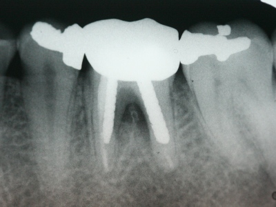 Failing tooth courtesy Mark Dennis, DDS