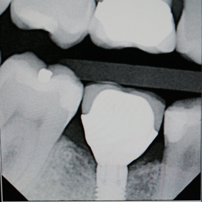 Implant crown by Mark Dennis,DDS