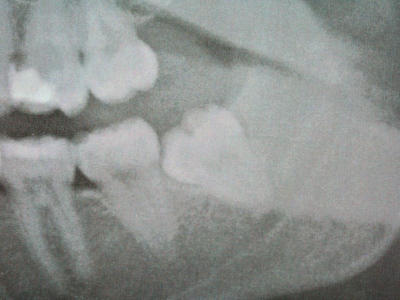 Radiograph by Mark Dennis,DDS