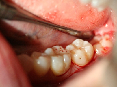 Third molar surgery by Mark Dennis, DDS