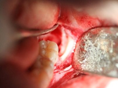 Third molar surgery by Mark Dennis,DDS