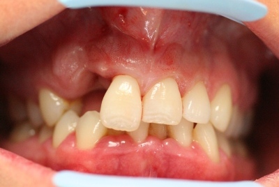 Patient before smile reconstruction by Mark Dennis, DDS