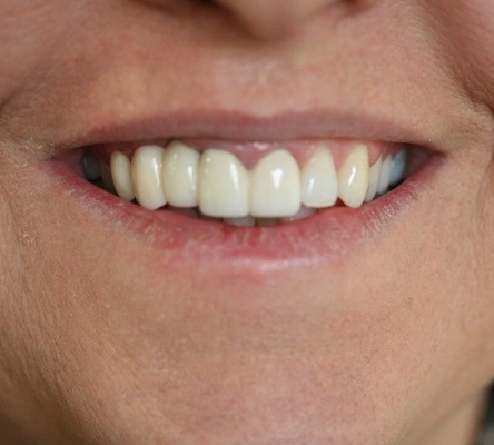 Smile reconstruction by Mark Dennis, DDS